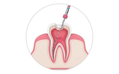 EndodentalTherapyRound