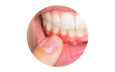 Gingivitis Treatment