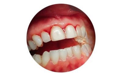 Periodontitis Treatment