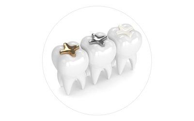 Tooth Sealants